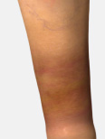 Hyperpigmentation