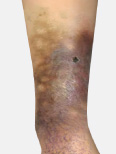 Lipodermatosclerosis