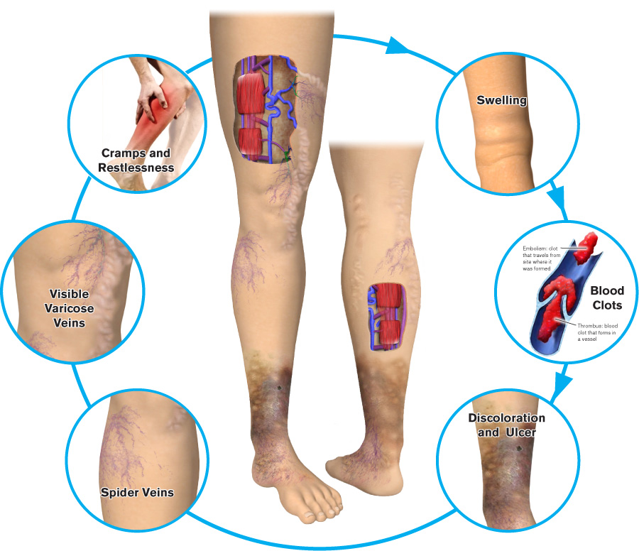 Progression of Varicose Veins