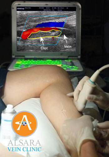 blood clot in leg ultrasound