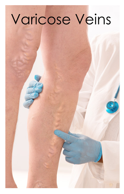 Varicose Veins Poster only