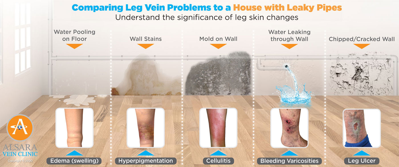 leg veins are like leaky pipes in a house