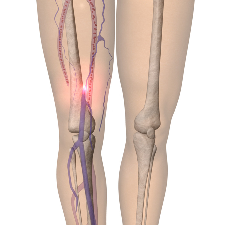 varicose veins treatment using laser