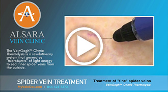VeinGogh Spider Vein Treatment