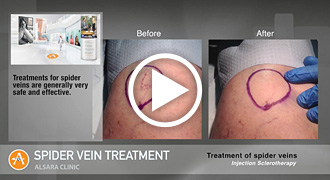 Spider Vein Treatments