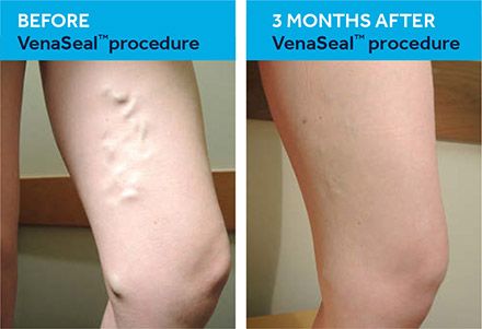 Before and After VenaSeal procedure